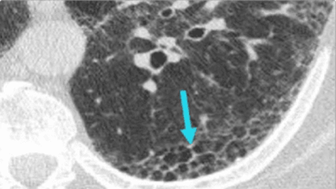Flear Chest Different Features of ILD on HRCT | ILD Radiology Rounds