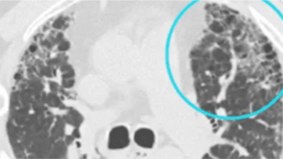 Ild Algorithm Radiology HRCT Technique for Evaluating ILD | ILD Radiology Rounds