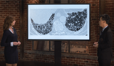 Interstitial lung disease in systemic sclerosis with a focus on chest CT