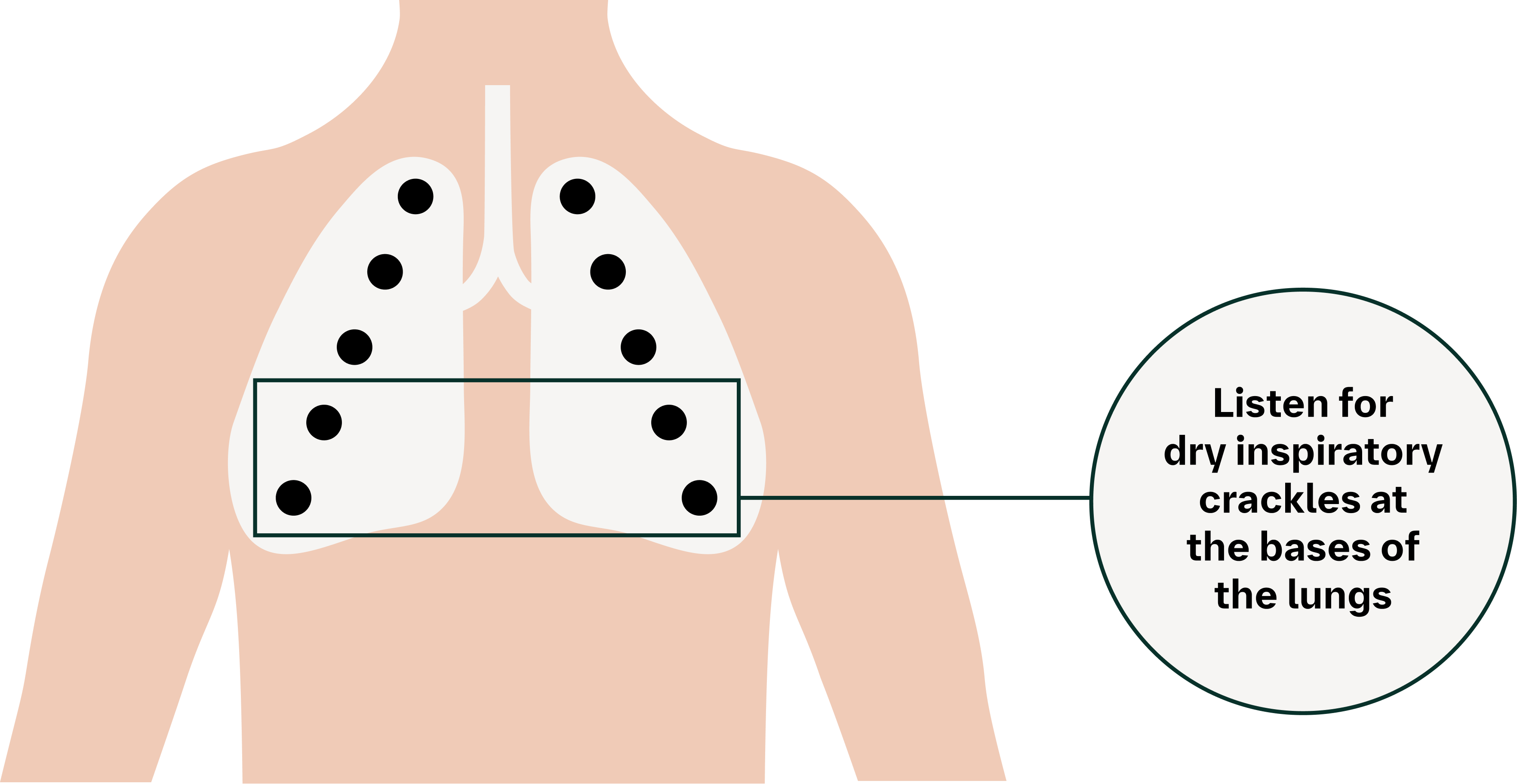 listen for dry inspiratory crackles at the bases of the lungs graphic