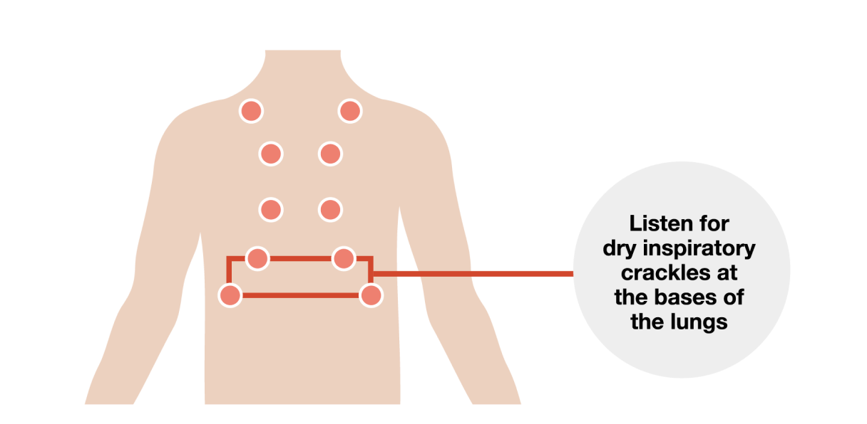 listen for dry inspiratory crackles at the bases of the lungs graphic