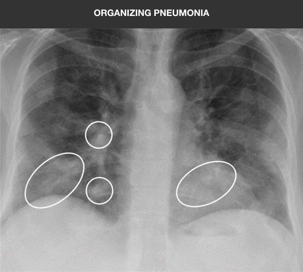 organizing pneumonia x-ray scan