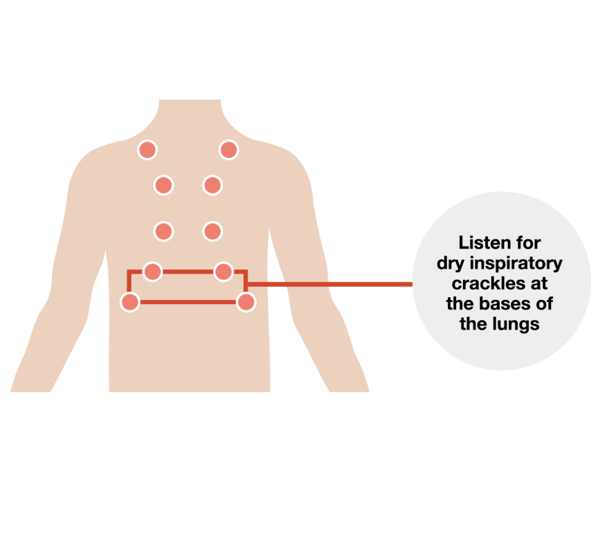 listen for dry inspiratory crackles at the bases of the lungs graphic