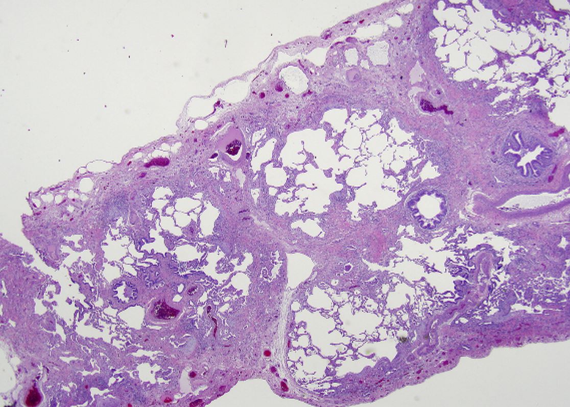 Uip Algorithm Diagnostic Criteria and Algorithm for IPF | Insights in ILD