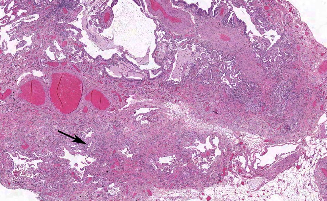 Uip Algorithm Diagnostic Criteria and Algorithm for IPF | Insights in ILD