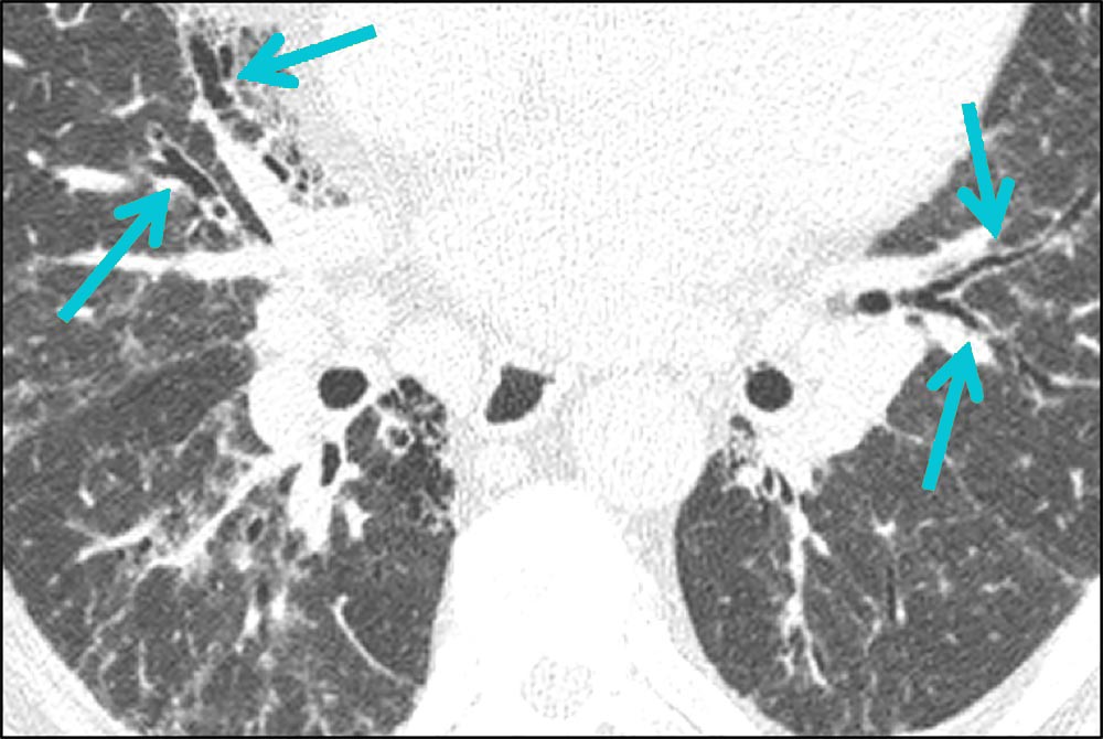 Traction Bronchiectasis
