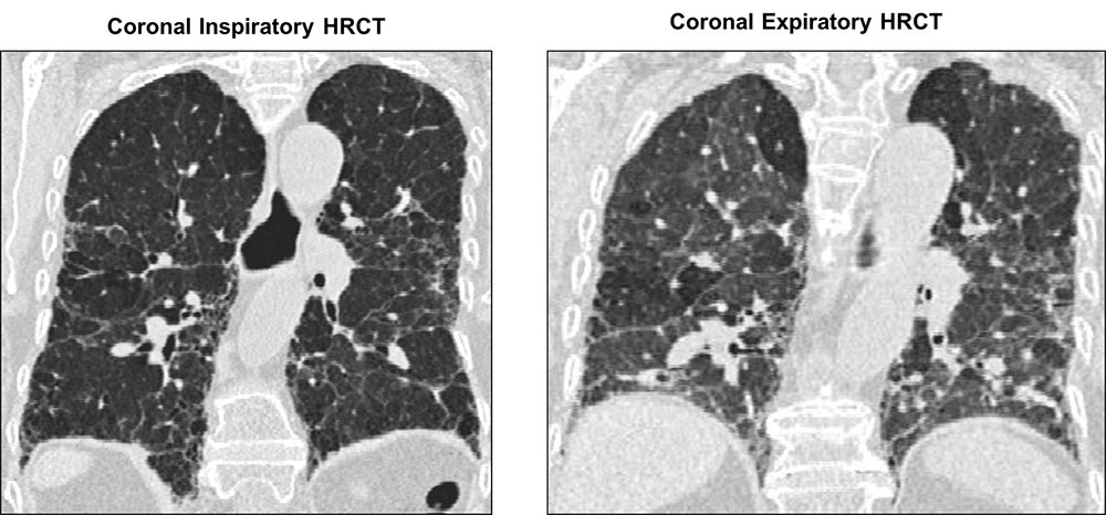 Coronal HRCT scan