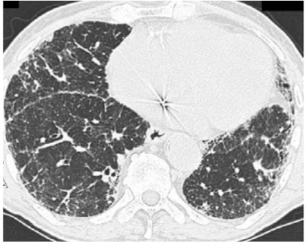 hrct scan of interstitial pneumonia