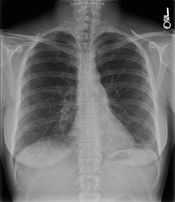 Patients With Dyspnea And/Or Cough Should Have An HRCT To Look For Signs Of ILD Because Chest X-Rays May Appear Normal
