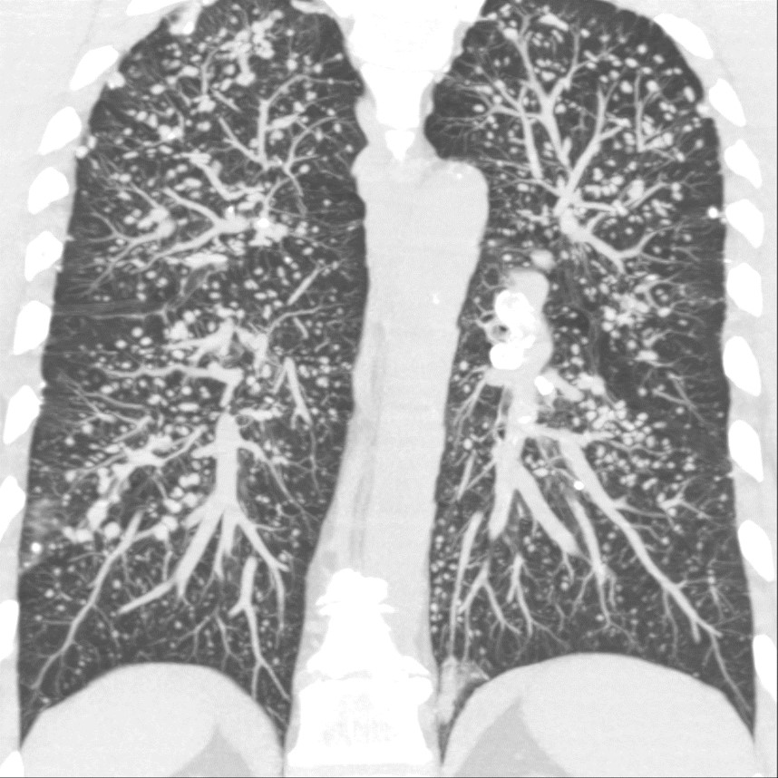CTD -Upper-lung predominance
