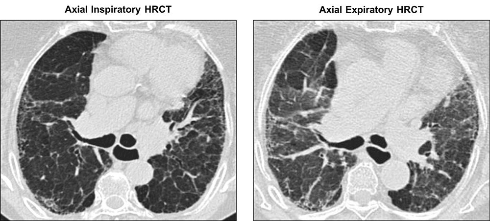 Axial inspiratory and expiratory HRCT images