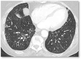 HRCT image of possible usual interstitial pneumonia