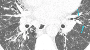 traction bronchiectasis hrct