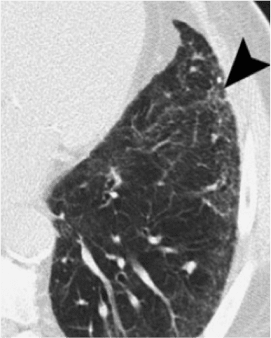 total lung capacity residual volume zoom before  hrct 3