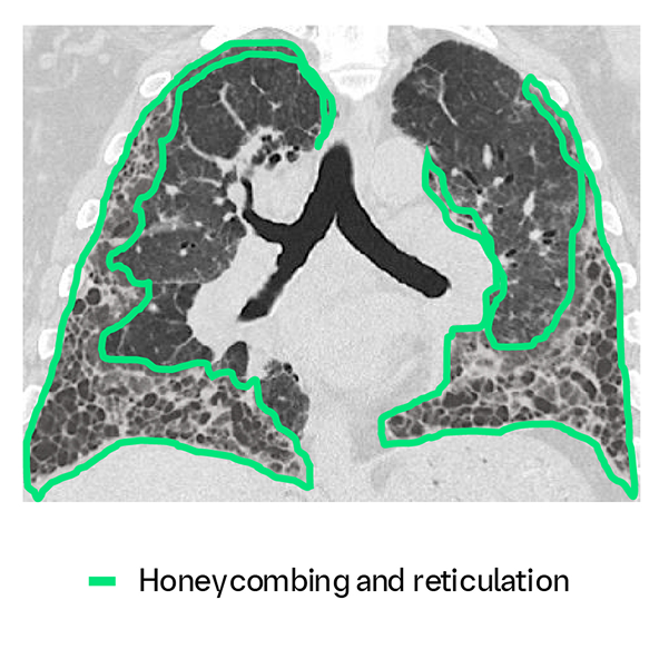 Ipf Radiopaedia IPF Risks | BIPI Medical & Clinical Resources