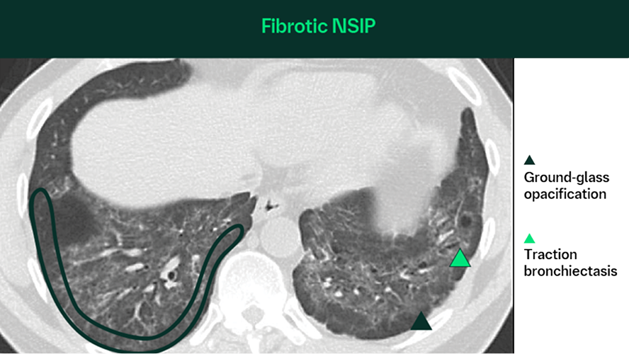 Nsip Classification HRCT Resources | BIPI Medical & Clinical Resources