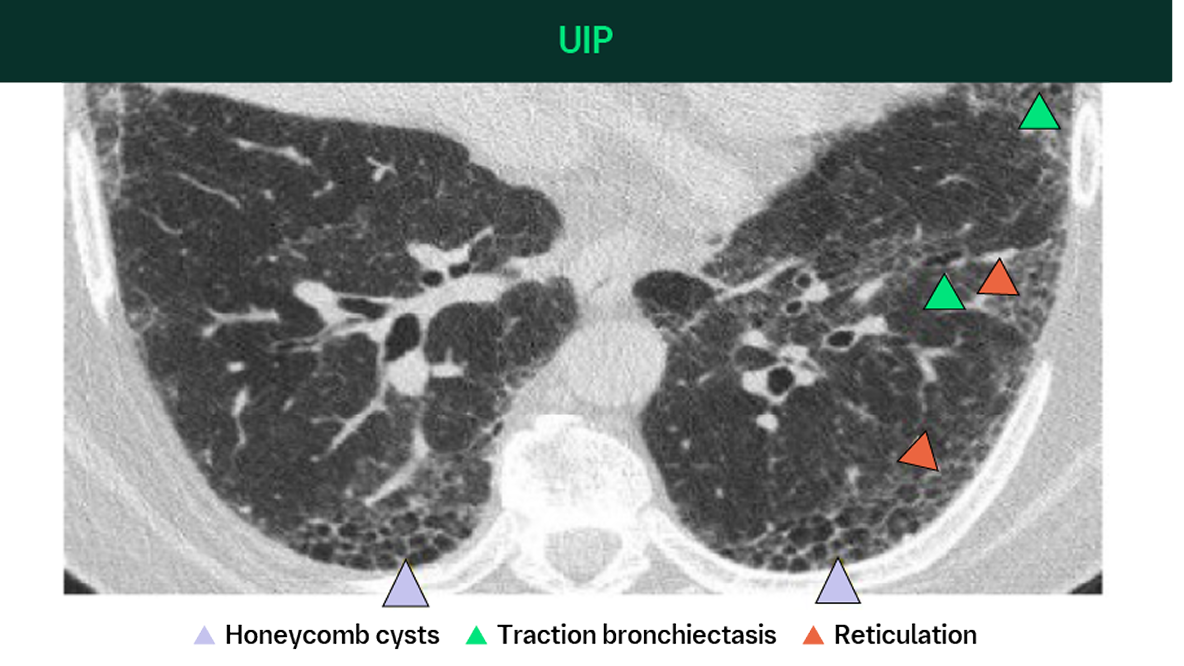 Uip Progression Time Course HRCT Resources | BIPI Medical & Clinical Resources