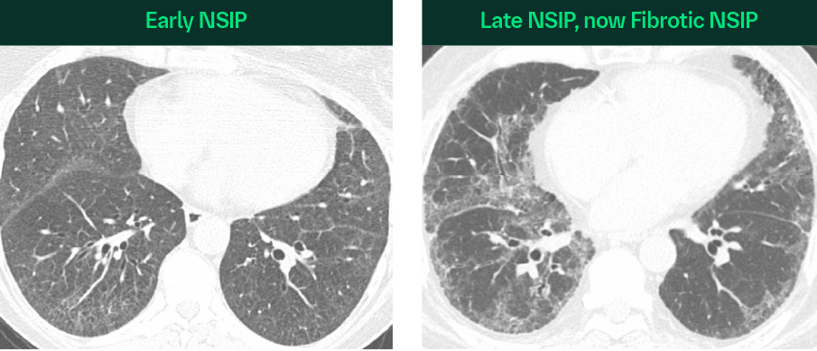 High-resolution Computed Tomography (HRCT) | BI Respiratory Education