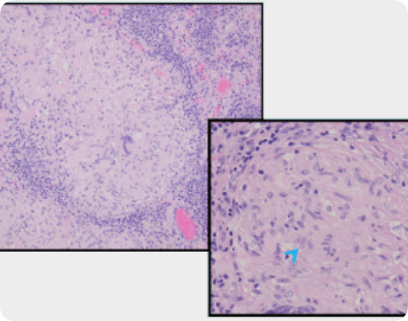 Lung histopathology showing inflammation