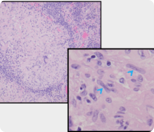 Magnified section of the lung histopathology imagery showing epithelioid histiocytes