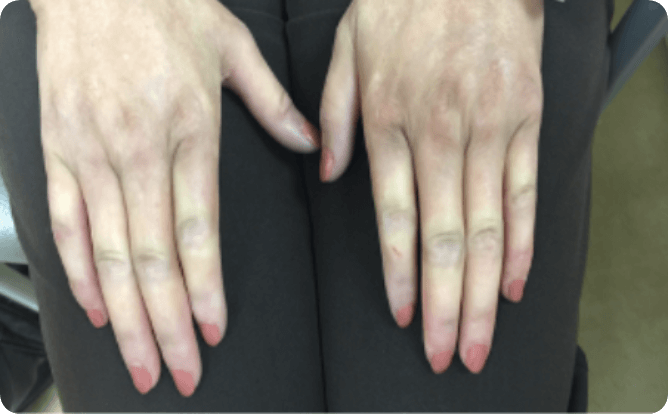 Hands showing signs of Raynaud's phenomenon