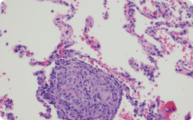 Pathology showing poorly formed granulomas/bronchiolocentric