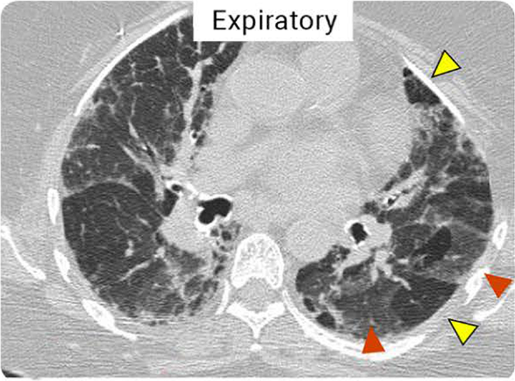 An expiratory HRCT scan showing four areas of air trapping