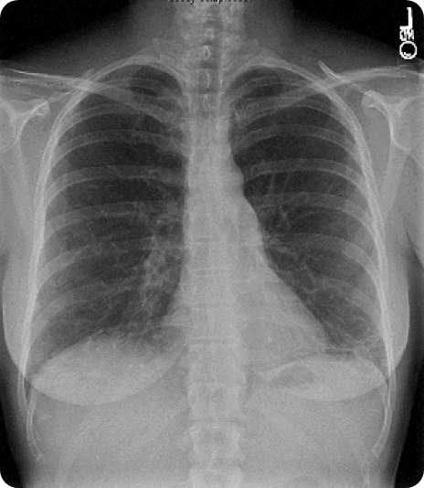 Signs of interstitial lung disease from a HRCT scan
