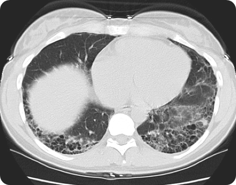 A HRCT scan revealing extensive lower-lung abnormalities