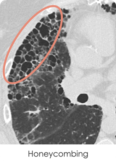 Honeycombing identified on a HRCT scan