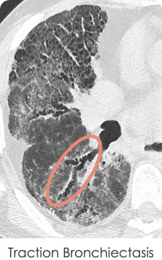 Traction bronchiectasis identified on a HRCT scan