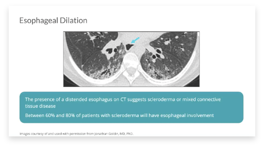 Watch the esophageal dilation video