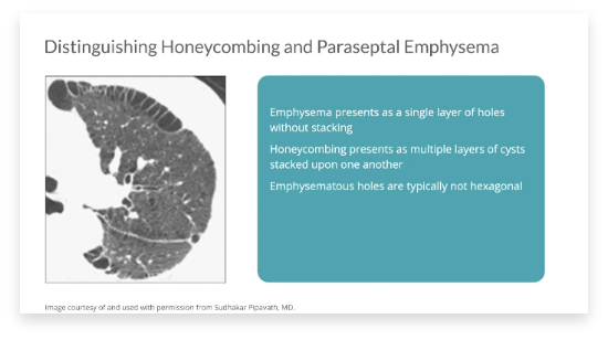 Watch the distinguishing honeycombing and paraseptal emphysema video